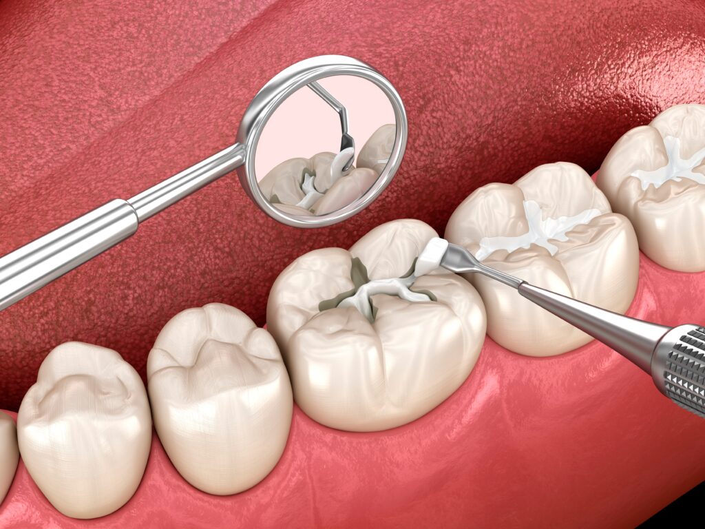 tooth cavity filling